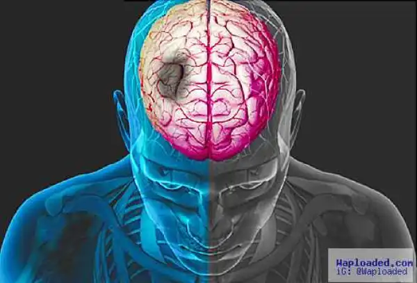 Health Tips: Simple Steps To Avoid Stroke